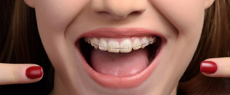 Diş Teli Bakımında Önemli Durumlar